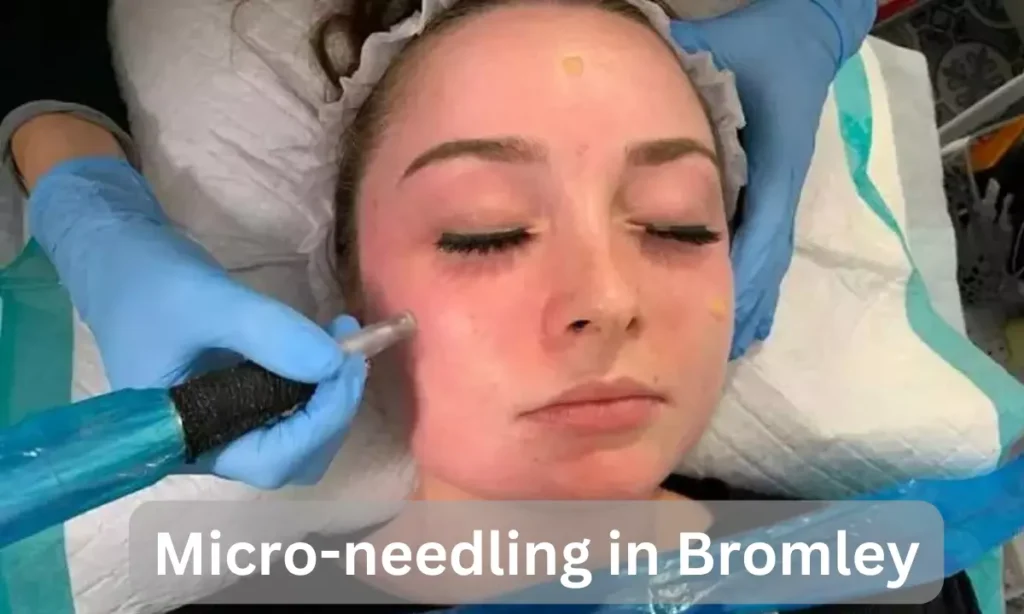 Micro-needling: Top Benefits and Results